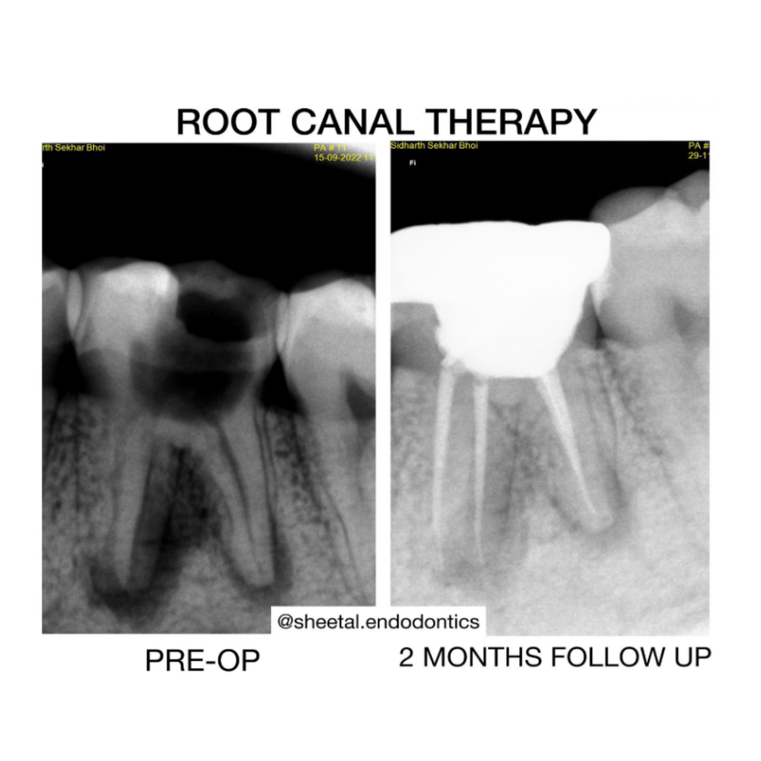 Root Canal