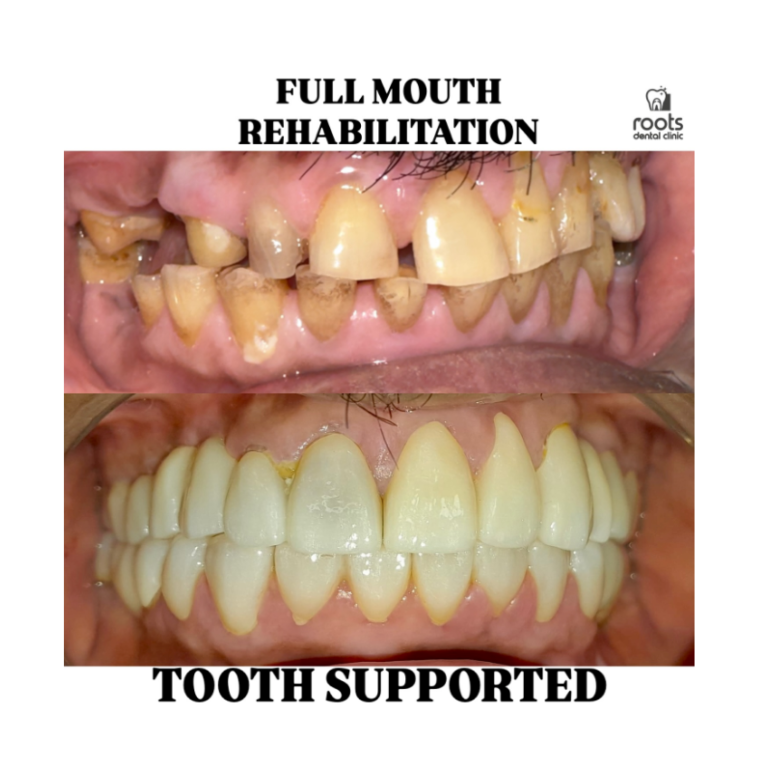Full Mouth Rehab